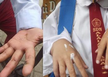 Hasil Pemeriksaan Dinkes Banjarmasin : Dari 187 Warga Alalak Utara, 71 Orang Menderita Kudis